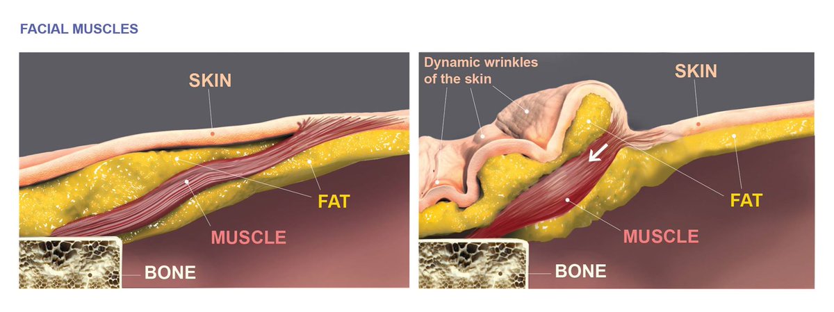 Anatomy_app's tweet photo. Did you know that facial muscles, when contracted, move skin rather than a joint? https://t.co/z5mX8EhxRB