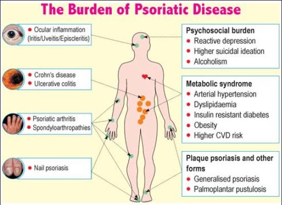 is psoriasis an autoimmune diseases