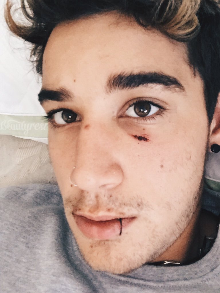 luke_brooks's tweet photo. Split my cheek again except this time on the other side https://t.co/RcB5E8Gx5t