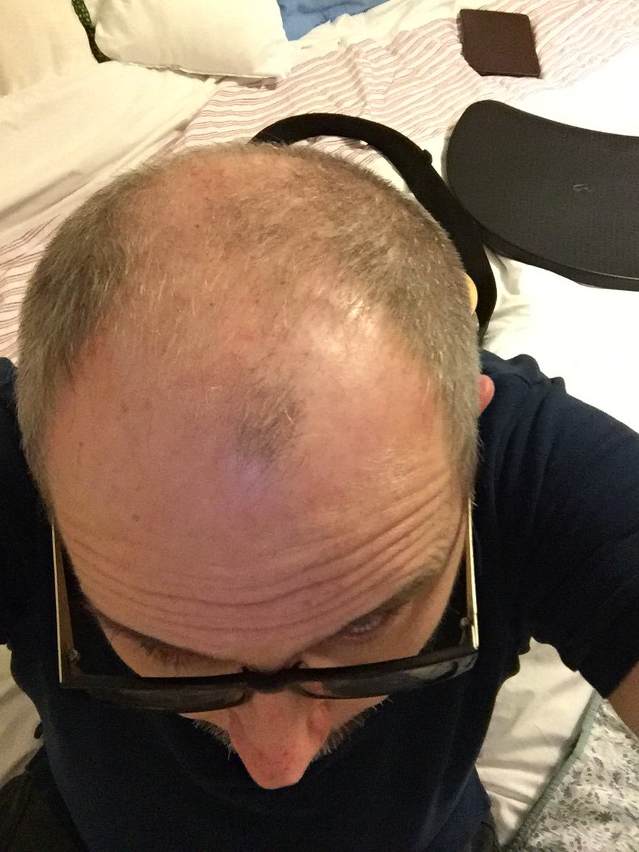 revgreenie's tweet photo. Okay mate have gone slightly too short on babyliss men's self hair trimmer #feedbackrequired #imbalding https://t.co/MsDgtRP4Lx