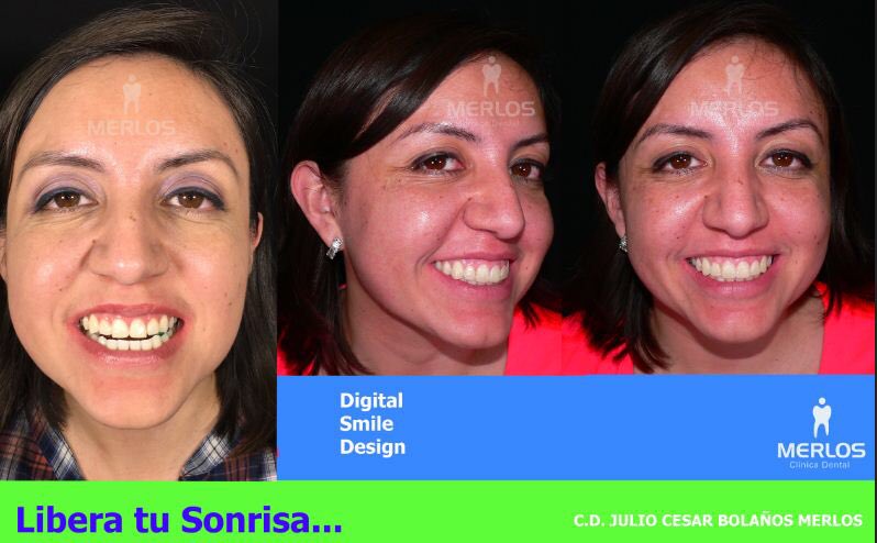 CDENTAL_MERLOS's tweet photo. Libera tu sonrisa con Diseño Digital de la Sonrisa y Mock Up! https://t.co/ihXZkhlOw1