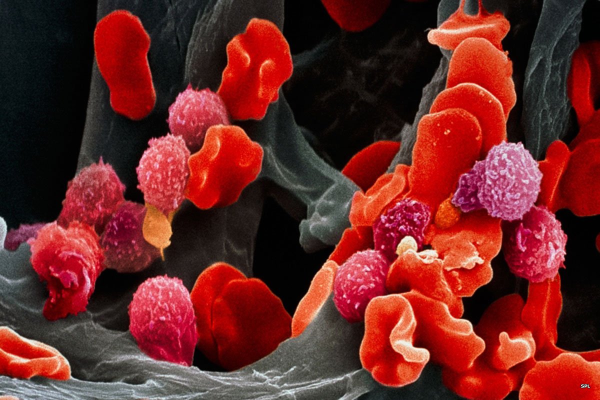 What labs are abnormal in childhood leukemia? How is leukemia diagnosed