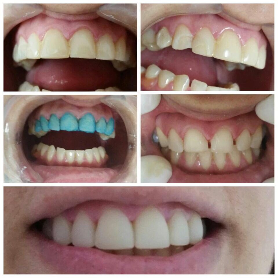 WorldSteticGye's tweet photo. Mira este Diseño de sonrisa con carillas de #Porcelana en @WorldSteticGye consulta GRATUITA @DrPeterValverde 6027410 https://t.co/B49FK7QQgb
