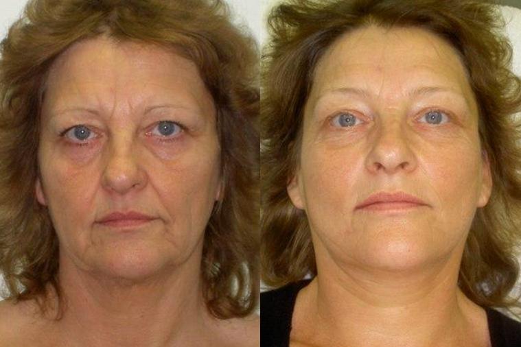 Морщины до после. Морщины до после. Омоложение до и после. Элос-омоложение лица до и после. Рестилайн витал скинбустер.