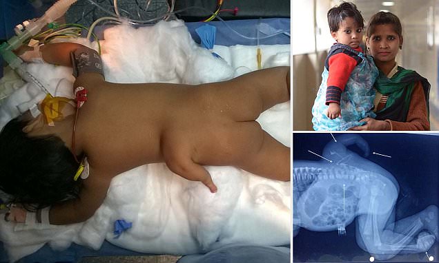 FaceEquality's tweet photo. Toddler with #polymelia has successful surgery to remove extra limb https://t.co/fpli9uJHho https://t.co/EbBNz0Qk0R