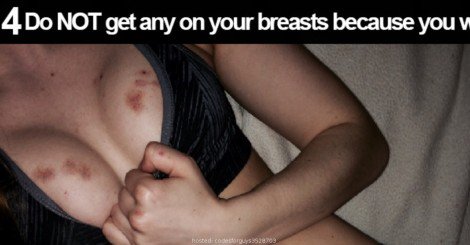 Facts About Hickeys You Must Know bit.ly/1oopirY