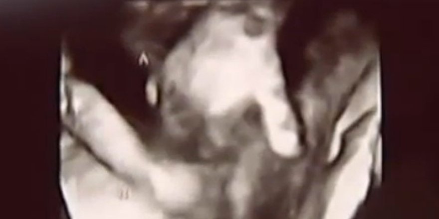 people's tweet photo. Stunning sonogram shows unborn child holding dying twin's hand https://t.co/tDGBPOF3rz https://t.co/VEJDLccPTQ