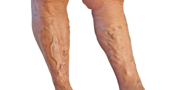 miamiveincenter's tweet photo. Leg #VeinProblems begin when the vein valves become weak. Learn more! https://t.co/LxQdIa6iUS https://t.co/eZKwABoTN0