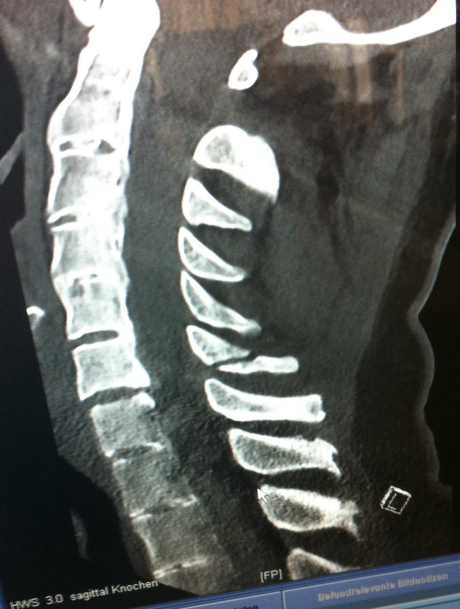 atmghn's tweet photo. fractures in #AnkylosingSpndylitis are dangerous - #FractureDislocation and #SpinalCordInjury are more frequent https://t.co/VbKDBdovGc