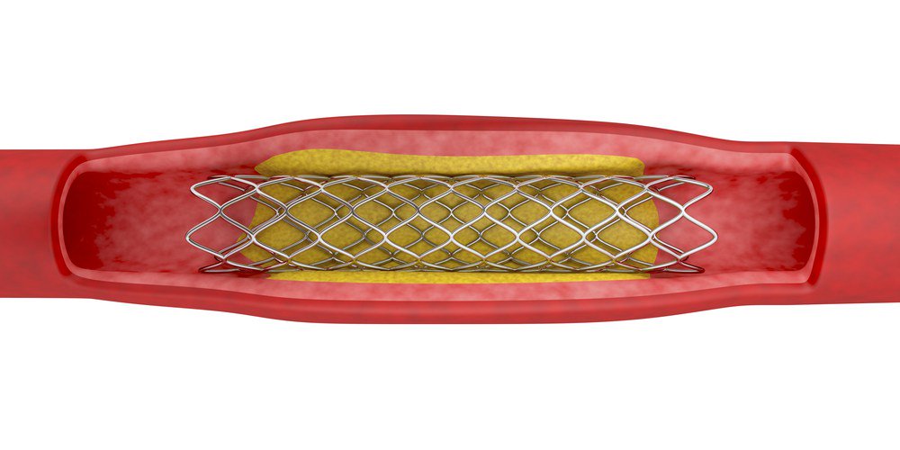 ErectileDoctor's tweet photo. Are Stents Effective at Treating ED? https://t.co/3QbYN2tMRU https://t.co/omZgw6iJbt