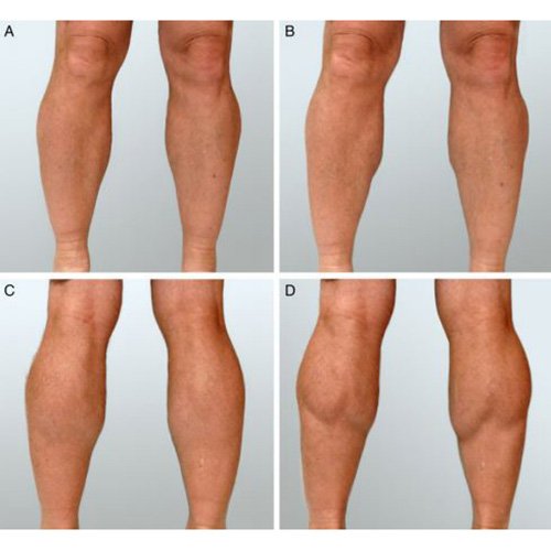 TheAestheticSoc's tweet photo. According to @ASJrnl study, #calfaugmentation w/ fat grafting has fewer risks than implants https://t.co/XCaEekgOWA https://t.co/FYDK91YhJf