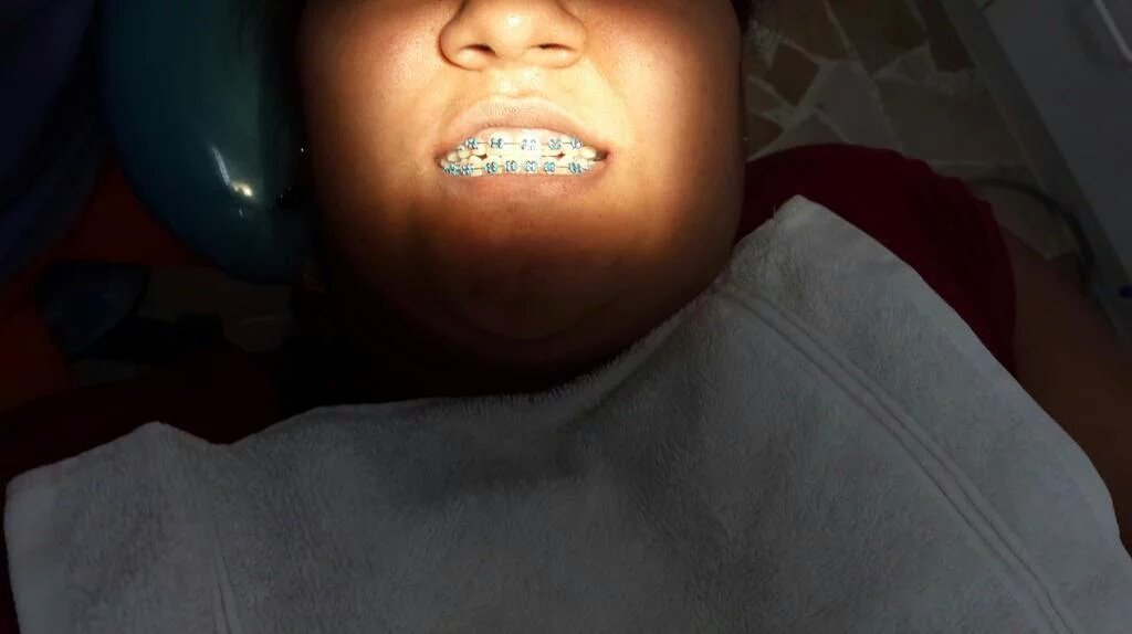 WorldSteticGye's tweet photo. Paciente con brackets metalicos. Mejora tu sonrisa en @WorldSteticGye Separa tu consulta SIN COSTO→ @DrPeterValverde https://t.co/6JHgKLPuz5