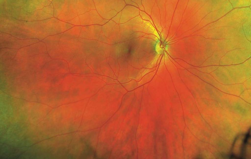 stcharlesvision's tweet image. This is your retina on Optos #lookforward #eyetech