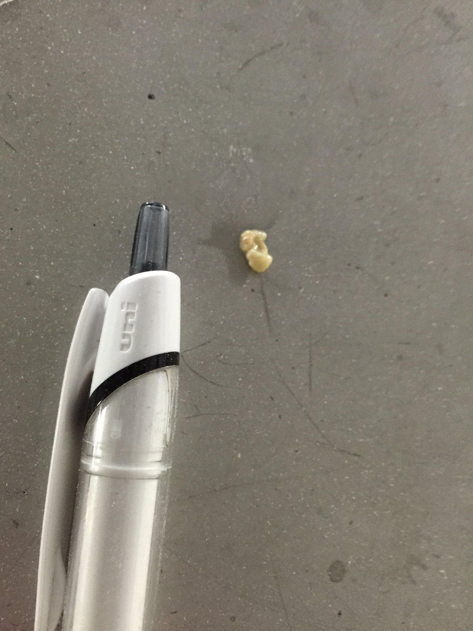 ぽたぽた くしゃみしたら特大級の臭い玉がでてきてビックリした ここ2日間くらい口が臭くてイライラしてたけどこれで気分もスッキリした感じです ちなみに記念写メ撮ったあと紙に包んでゴミ箱へ捨てたけどあの癖になる臭いを嗅ぎに何度も戻りました