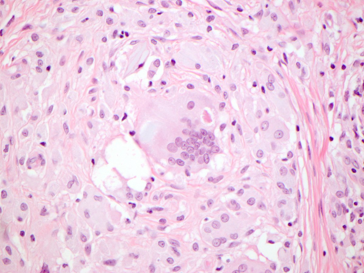 DermpathMGH's tweet photo. foreign body #giantcell reaction to polarizable suture material w/ #asteroidbody #dermpath #pathology https://t.co/jS9tO98YSw