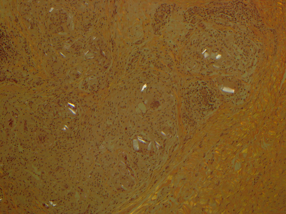 DermpathMGH's tweet photo. foreign body #giantcell reaction to polarizable suture material w/ #asteroidbody #dermpath #pathology https://t.co/jS9tO98YSw