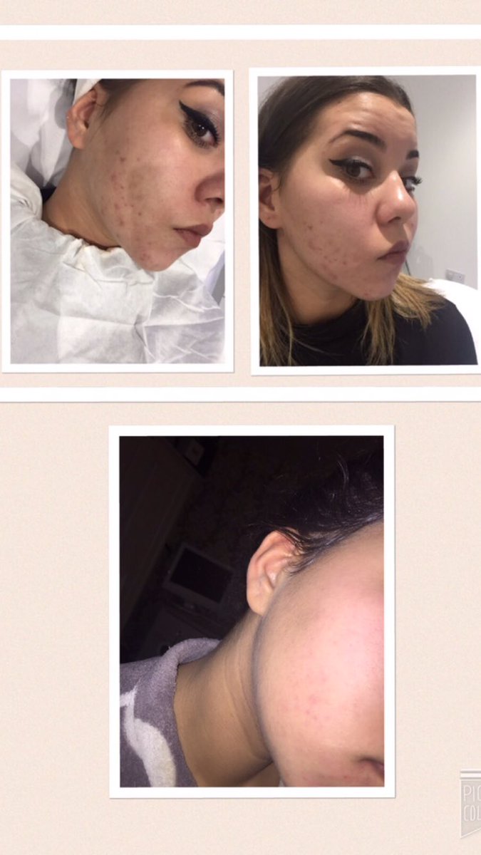 CrystalJQBranch's tweet image. Do you suffer with breakouts? Look no further than crystal clear skin. Clients results just 1 month after treatment!