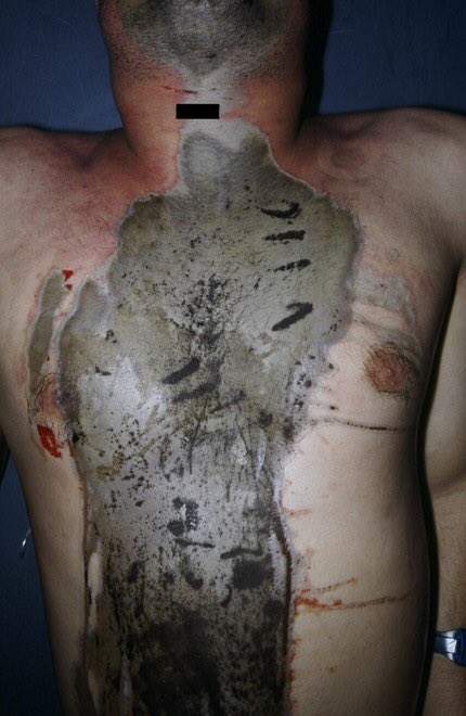 mofecuma's tweet image. @CybilHella @LeafyIsHere #causticingestion