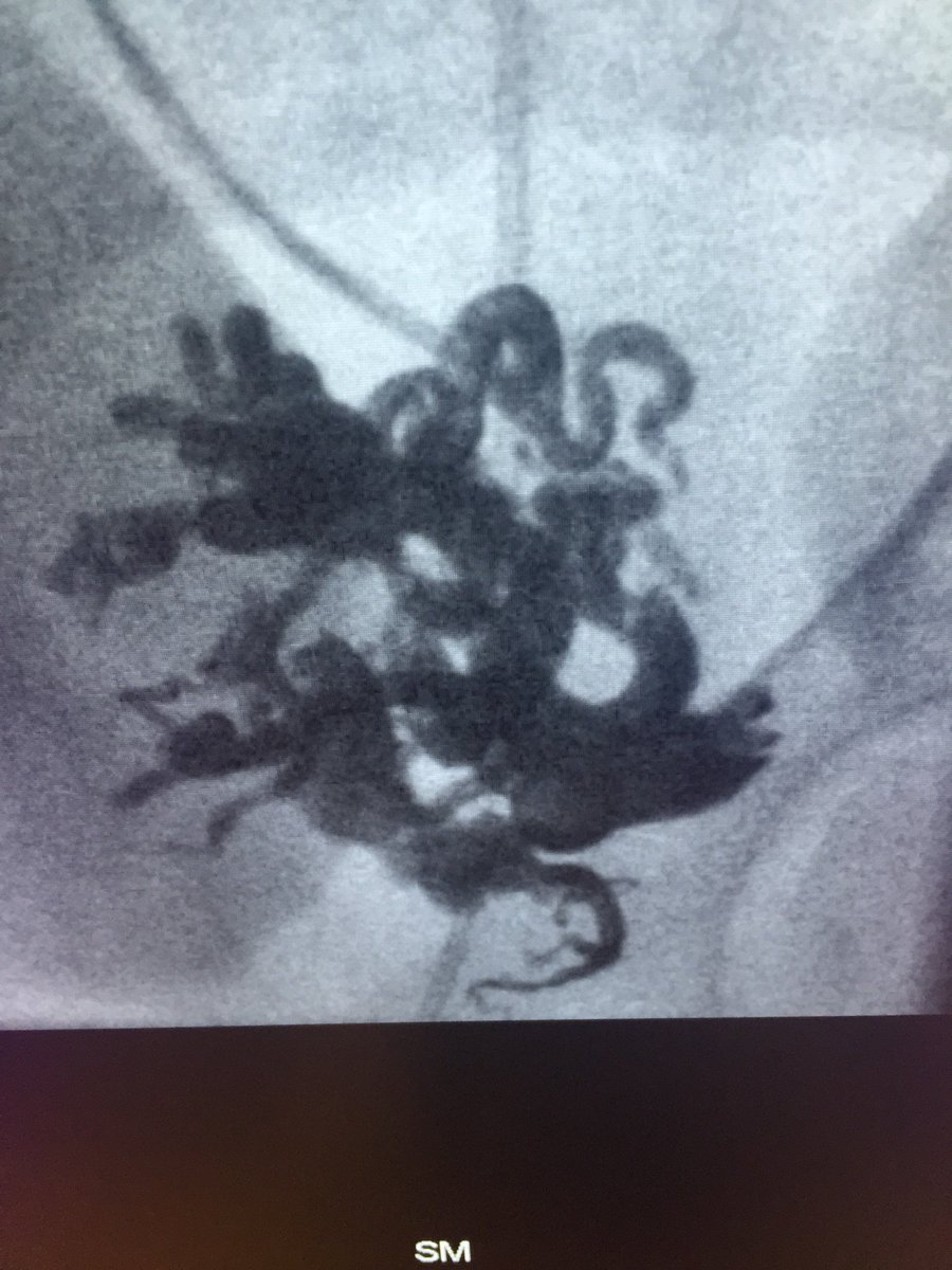 Live from <a href="/MountSinaiNYC/">Mount Sinai Health System</a> West #IRad: Pelvic #AVM treated w/ #onyx <a href="/Medtronic/">Medtronic</a> <a href="/AdFriedma/">Adie Friedman</a> <a href="/roblookstein/">Robert A Lookstein MD, MHCDL</a> #justglueit