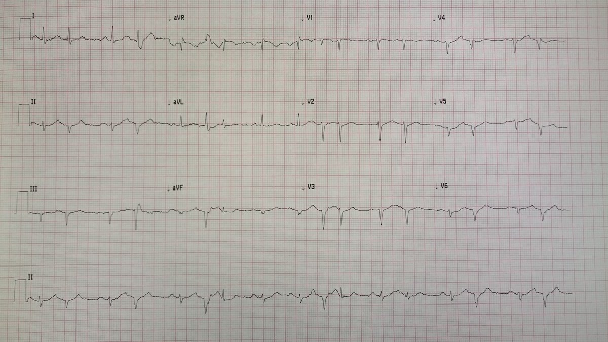 CC_CPD's tweet photo. Morning all. 65 YOM collapse 2hrs previous to arrival. No CP/SOB. Hx HTN. BP 100/70. All other obs NAD. @prehospECG https://t.co/UFrpQpSND9