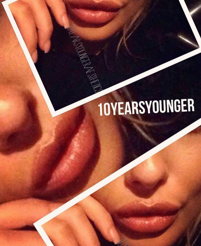 Beautiful lip creation by our specialist #lip #fillers #pout #kyliejenner #beautiful #aesthetics