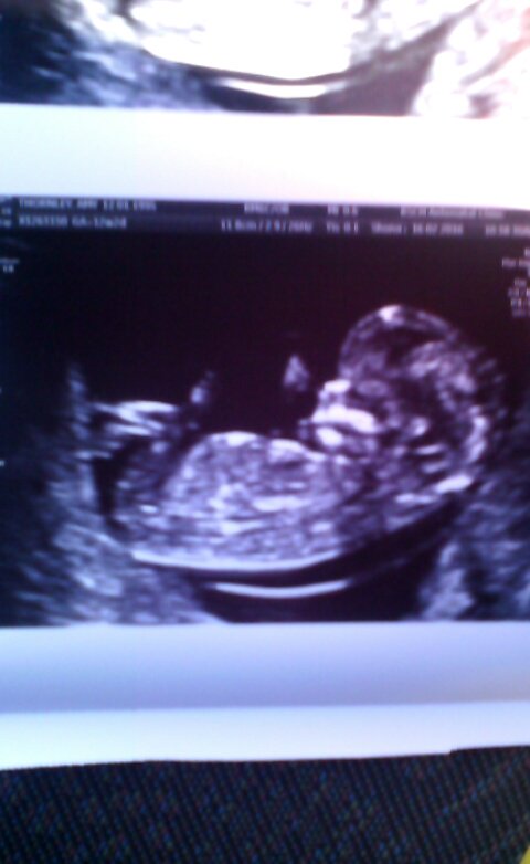MissAmyFrancesT's tweet photo. 12 weeks pregnancy scan <3 #soinlove #12weekscan #goingquickly https://t.co/bHgxu7VhIN