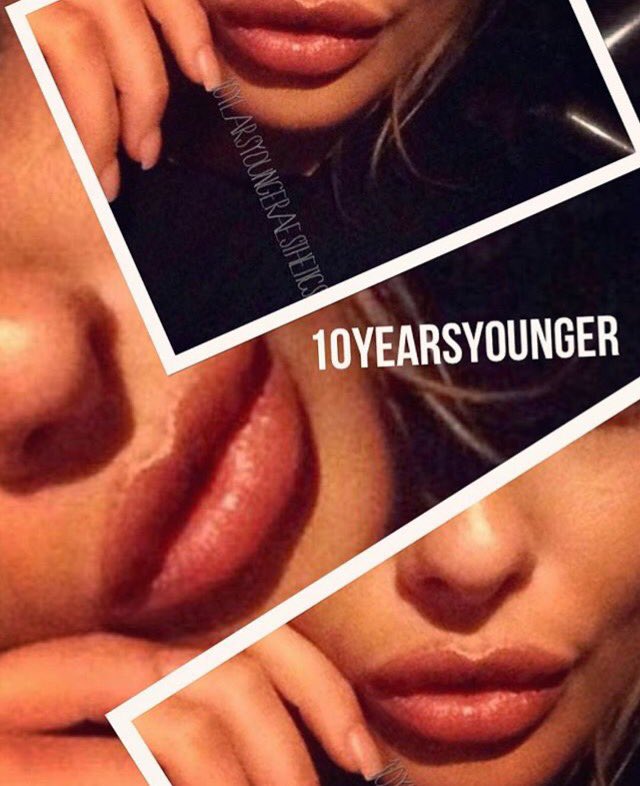 Beautiful lip creation by our specialist #lip #fillers #pout #kyliejenner #beautiful #aesthetics