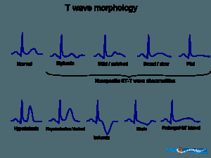 RewAU's tweet image. Something not quite right about those T-waves ? 4 causes of abnormal T-waves.. foamlinks.com/2016/02/weird-…