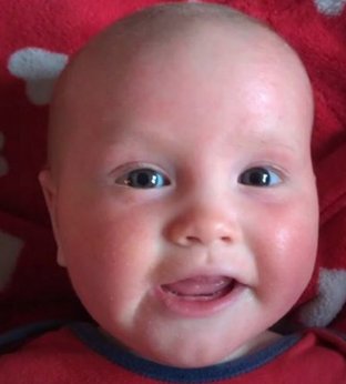 millihill's tweet photo. This time 2 years ago our living #eczema hell was ending. Just 48 hours into treatment with @DrAronEczema Thank You. https://t.co/nSJOHfKI8N