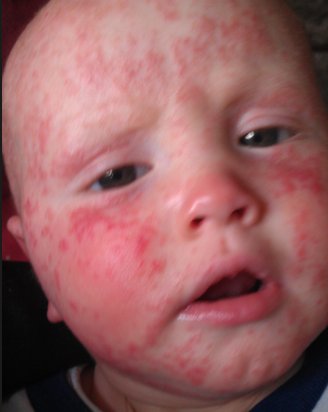millihill's tweet photo. This time 2 years ago our living #eczema hell was ending. Just 48 hours into treatment with @DrAronEczema Thank You. https://t.co/nSJOHfKI8N