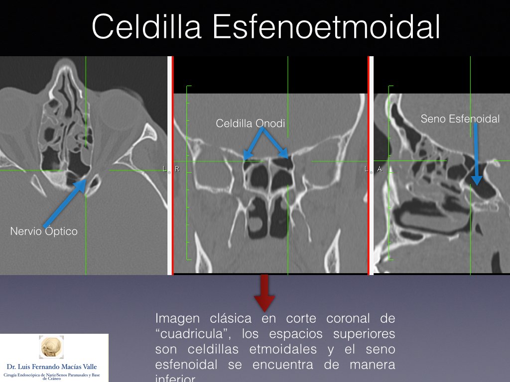 MaciasORL's tweet photo. #Onodi: celdilla etmoidal neumatizada superior y lateral al seno esfenoidal. Riesgo para el #nervioóptico #rinologia https://t.co/1iUqkMRsj1