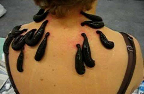 LEACH THERAPY
75% of clients agreed,once awakening from a coma felt only a mild burning feeling in their extremities