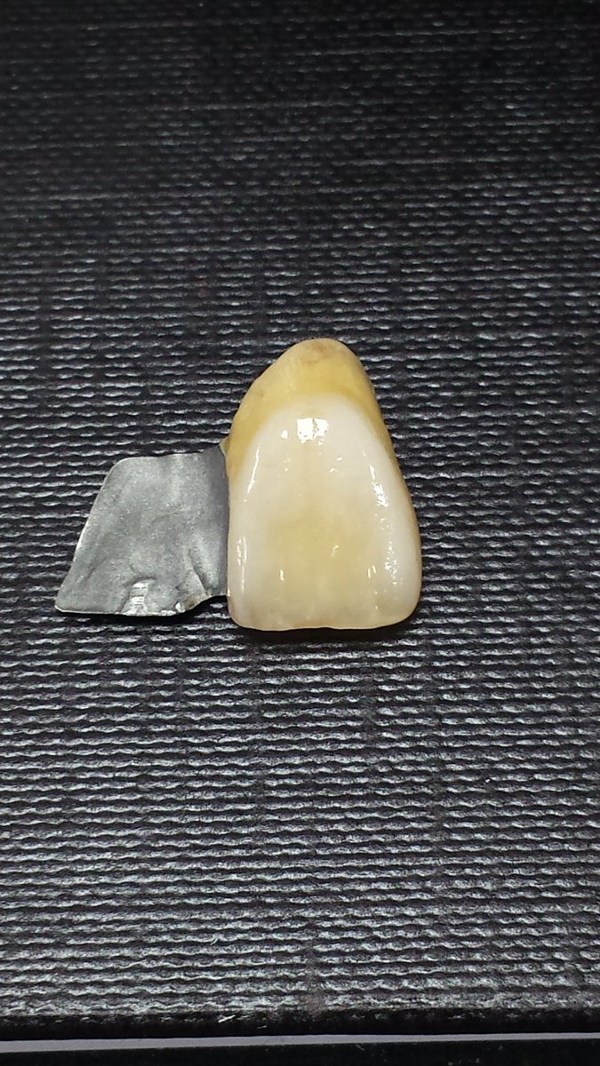 joselumelgar's tweet photo. Maryland bridge to match highly characterised adjacent teeth. Waiting results. With #IPSInLine #ivoclar https://t.co/7HROxowa5h