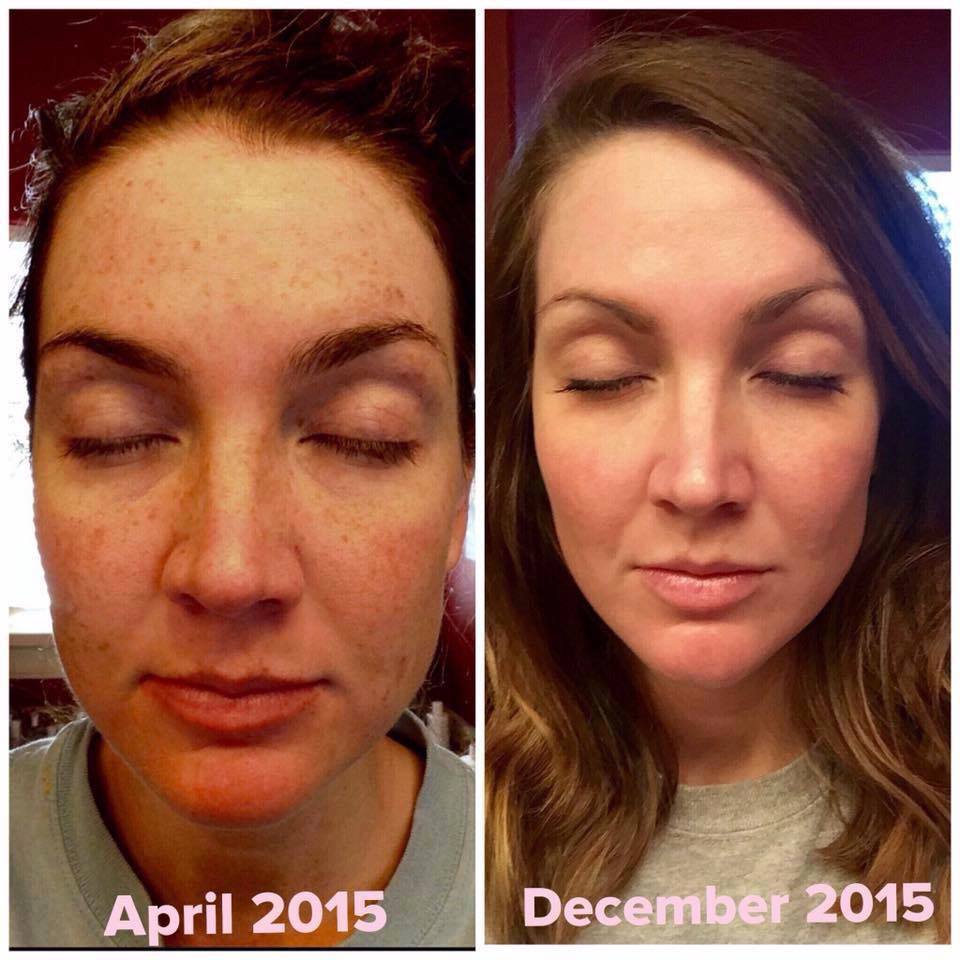 back2simple's tweet image. So fun to see results with Rodan+Fields products!! Message me when you are ready to try! buff.ly/24KEh0o