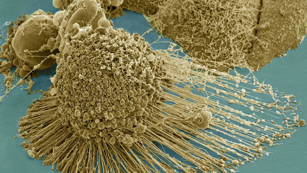 PBS's tweet photo. Immunotherapy works in about 20% of cancer patients. Those stats may soon change. https://t.co/eFmSZh8MKw #NOVAnext https://t.co/bAoEy0Yxwv
