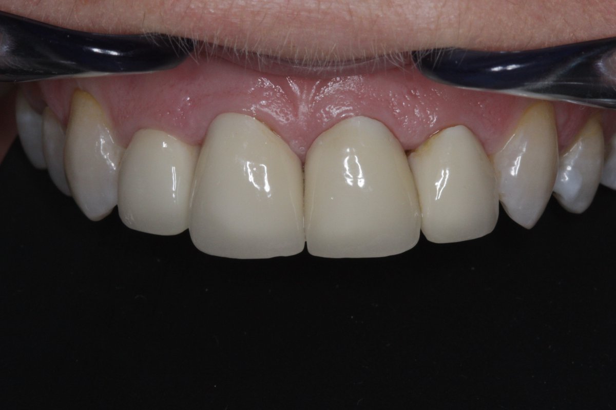 visiondentalab's tweet photo. Emax Crowns https://t.co/5ZBaSqo5Qt