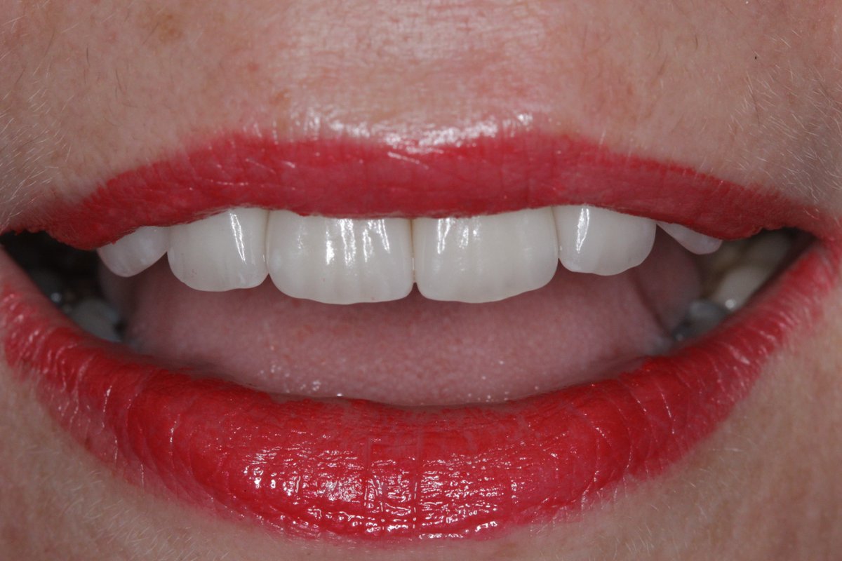 visiondentalab's tweet photo. Emax Crowns https://t.co/5ZBaSqo5Qt