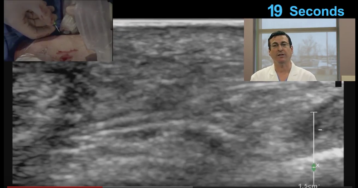 Pedal Ultrasound Access In Under 60 Seconds
youtu.be/lTuKjFGCl94 #cliGlobal #CLI