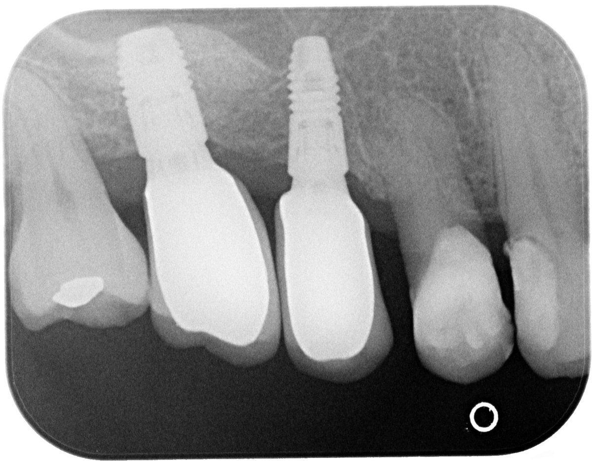 Adam Noble (@albertplace) on Twitter photo Sinus graft and #Astra EV implants restored with Atlantis screw retained crowns <a href="/NickD_H/">Nick Daily-Hunt</a> <a href="/DrRobCarson/">Robin Carson</a> <a href="/suzihu/">Sue Hughes</a> Sinus graft and #Astra EV implants restored with Atlantis screw retained crowns <a href="/NickD_H/">Nick Daily-Hunt</a> <a href="/DrRobCarson/">Robin Carson</a> <a href="/suzihu/">Sue Hughes</a>