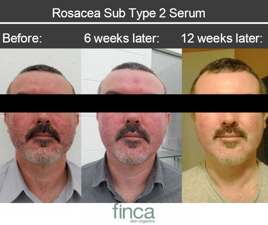 soolantra alternatives
