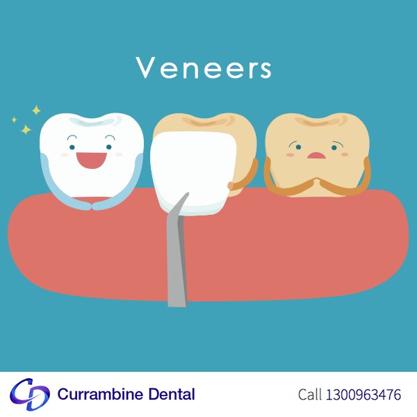 CURRAMDental's tweet photo. Veneers are a thin layer of porcelain that is uniquely designed to fit directly over the surface of a tooth. https://t.co/v0gAPS2LDJ