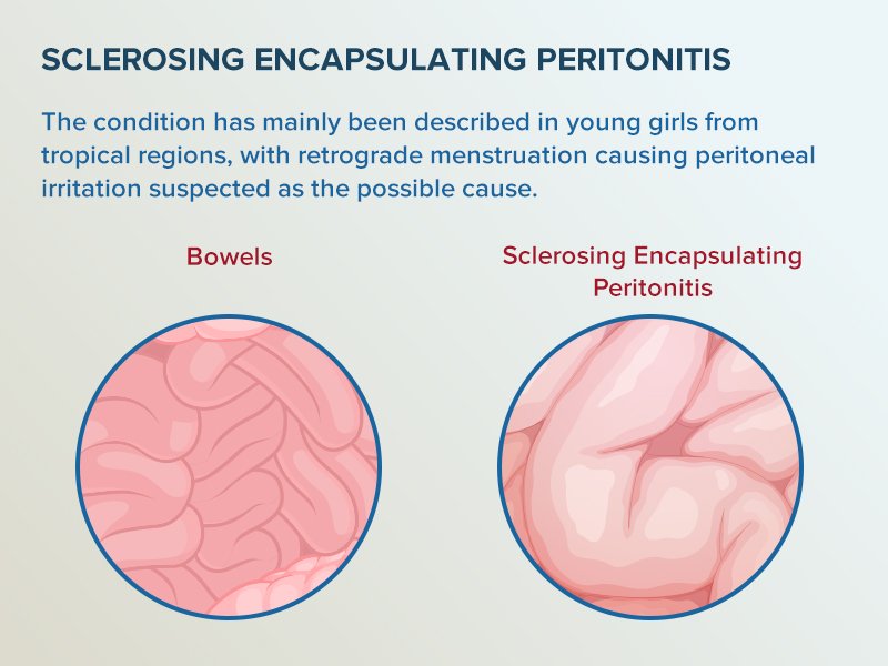 This week's top search term was sclerosing encapsulating peritonitis