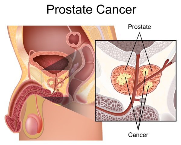therapy_proton's tweet photo. RT https://t.co/5z6d6LUBFj Have we unnecessarily treated too many cases of #prostate #cancer? … https://t.co/Ag3H5vC30A