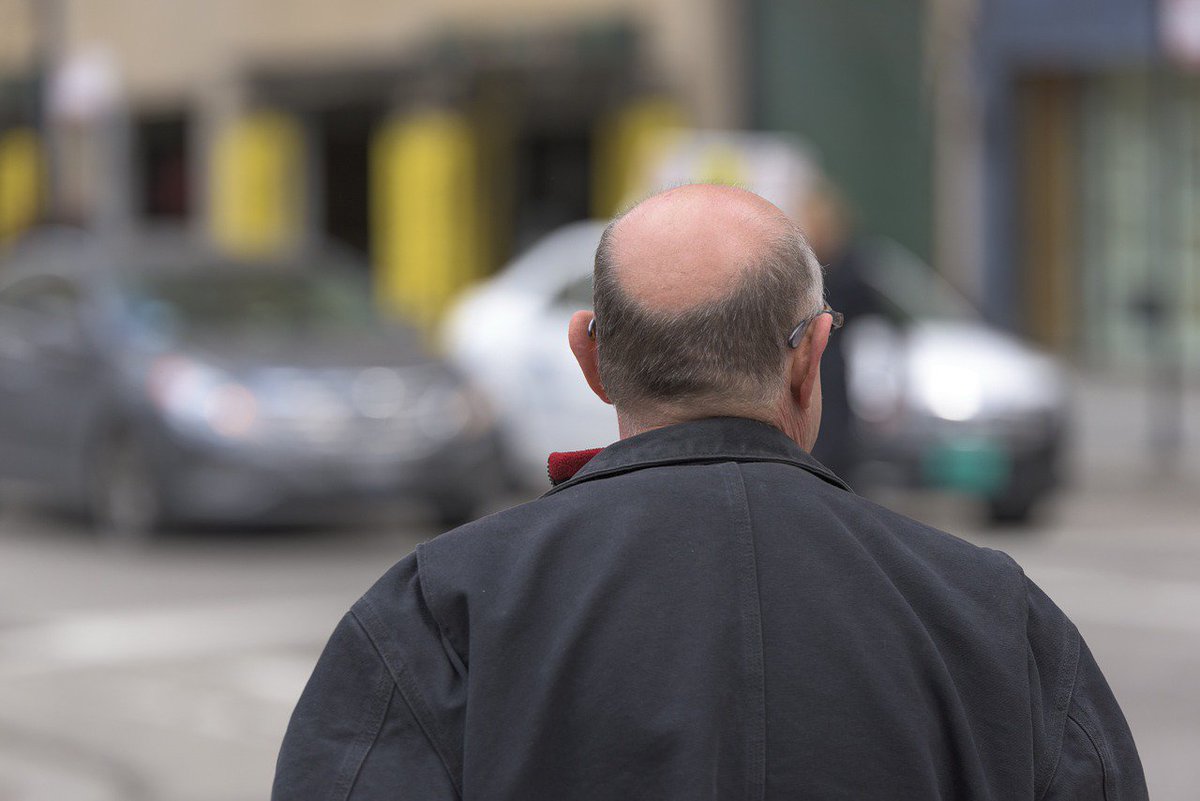 therapy_proton's tweet photo. RT https://t.co/Z8kwQVwl6q Could #baldness be an indicator of #prostatecancer risk?  https://t.co/z2q3S7VfGO https://t.co/H2RoCslLcY