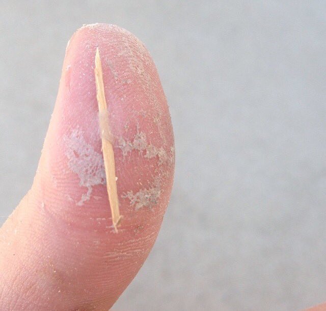 tyylerhughes's tweet photo. Flashback Friday to when I got this stuck in my thumb. #thanksTPC https://t.co/skqqrbeRxS
