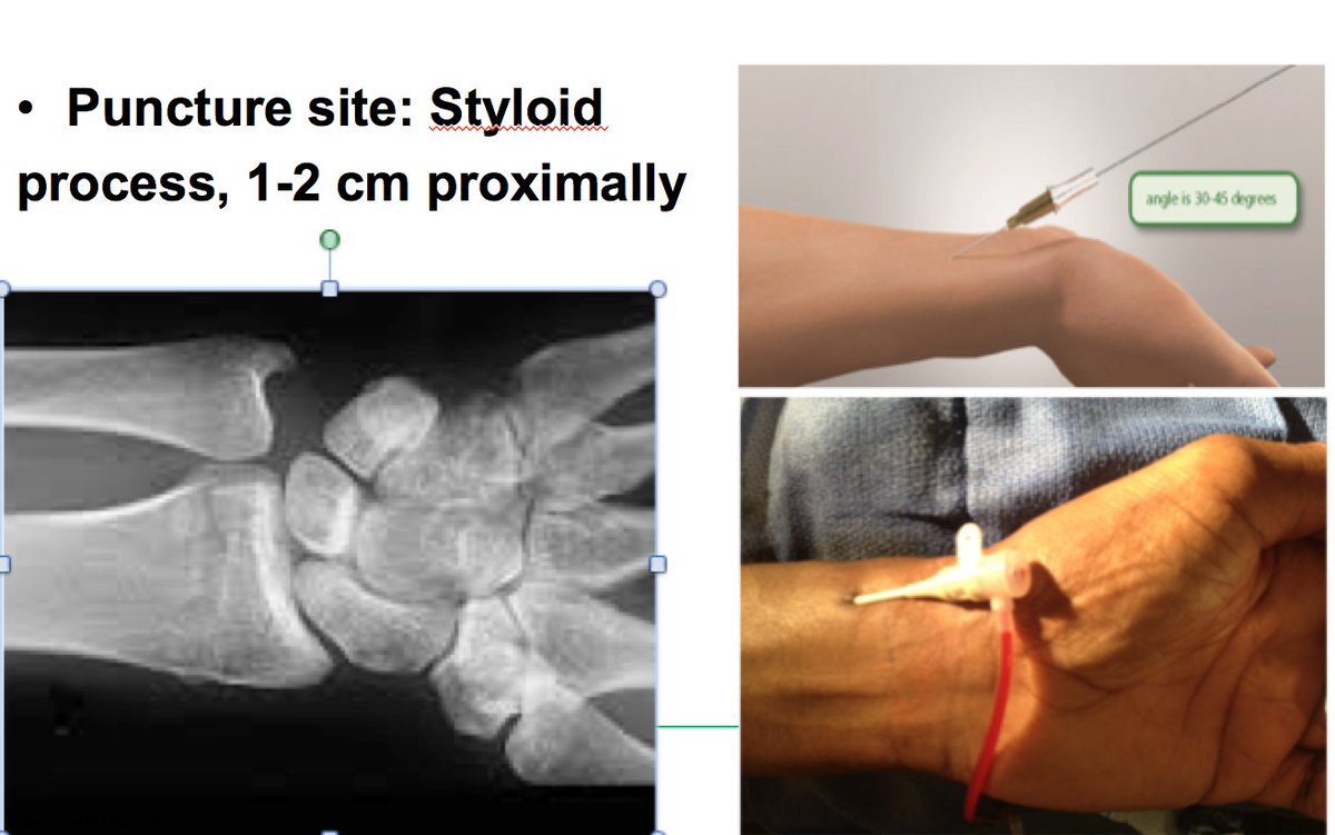 MUSCVIR's tweet photo. #Radialtips - access at level of the styloid process, perform Barbeau test prior, give heparin and vasodilator #iRad https://t.co/2APXGaYYS5