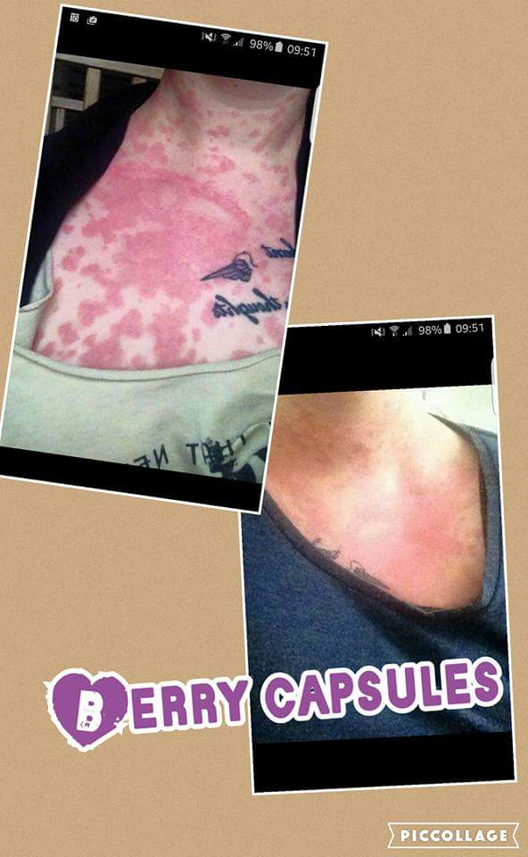 ***Calling psoriasis suffers*** Look at this lovely ladies results!! Amazing!! 🍇🍇💜💜