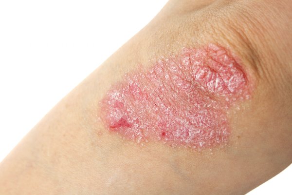 ThinkTankExile's tweet photo. How Topical #Cannabis Affects Psoriasis - https://t.co/ZQy0GHnffV #psoriasis #mmj https://t.co/bldVUSJjpY