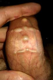 Beading genital Penis Piercing: