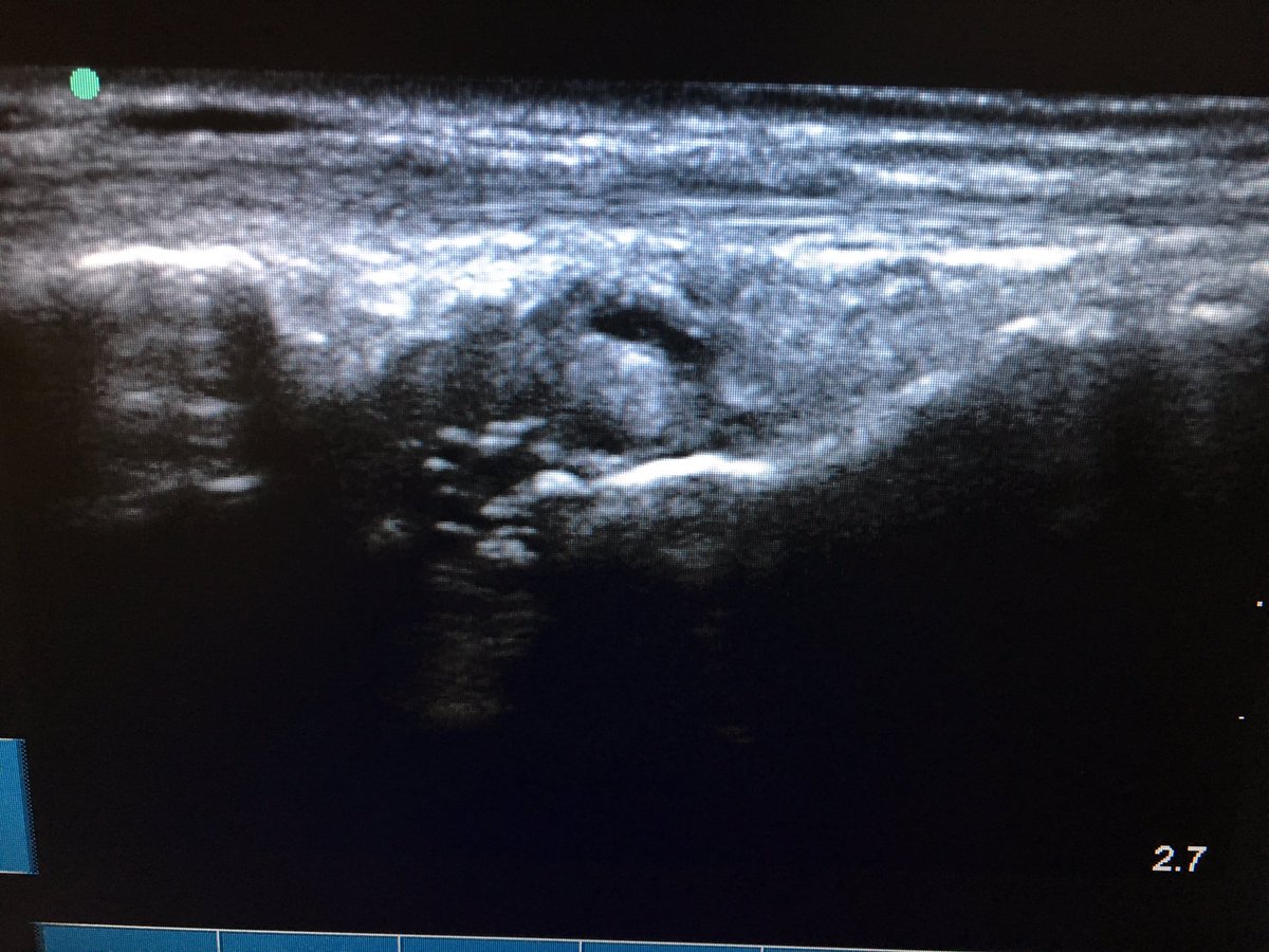 mcpoll0417's tweet photo. Scan by @ScottEpsley, mucoid ganglion off scapholunate @mskultrasound @Douglas_M_White @Niek_NTe #msksonography https://t.co/NKvnh9Qz9D